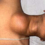 KIMS Doctors Save 21yr Old with Leaking Artery from Heart