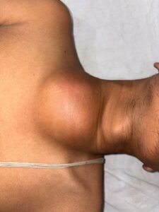 KIMS Doctors Save 21yr Old with Leaking Artery from Heart